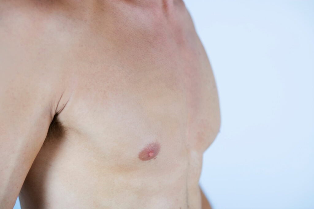 Adult Male Breast Reduction
