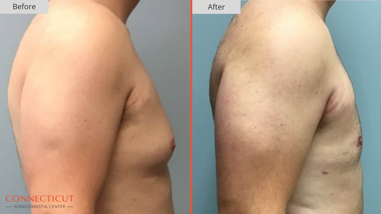 Connecticut Gynecomastia Center Before After 10A