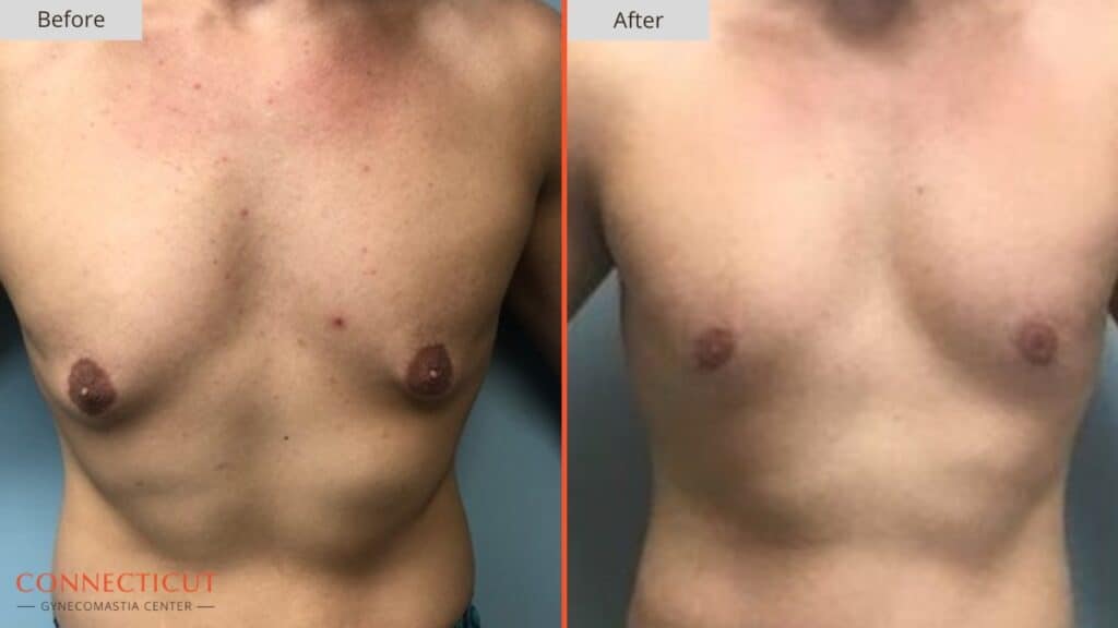 Connecticut Gynecomastia Center Before After 11A