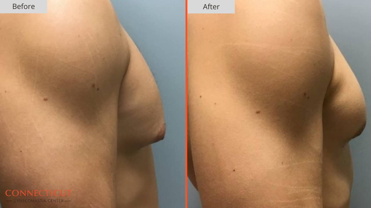 Connecticut Gynecomastia Center Before After 12A
