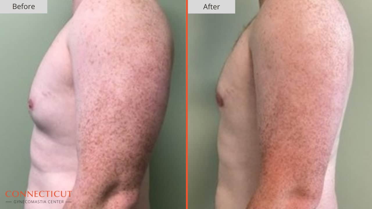 Connecticut Gynecomastia Center Before After 14A