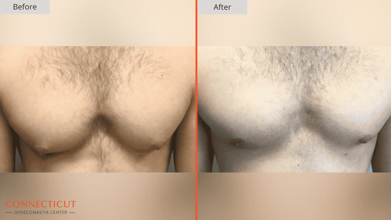 Connecticut Gynecomastia Center Before After 15D