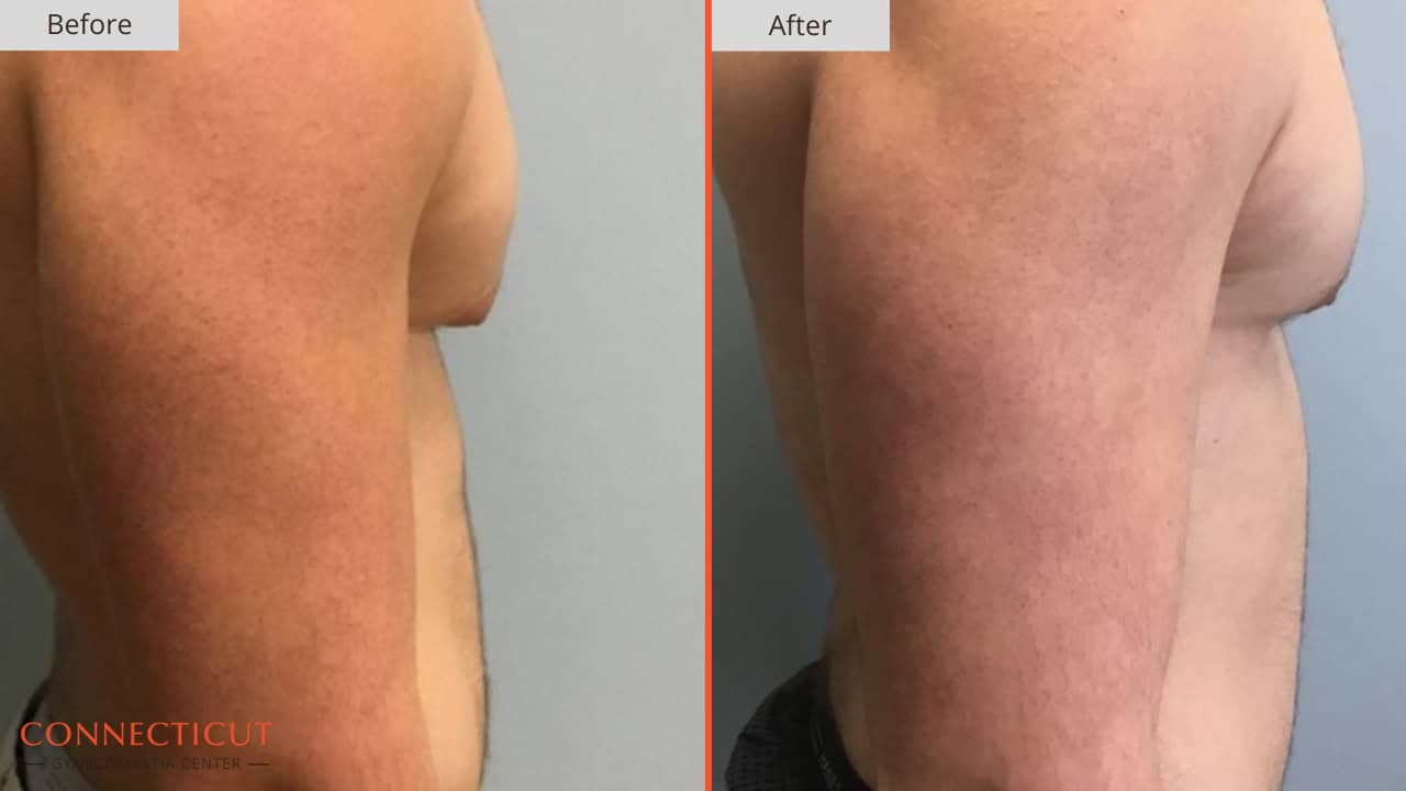 Connecticut Gynecomastia Center Before After 16A