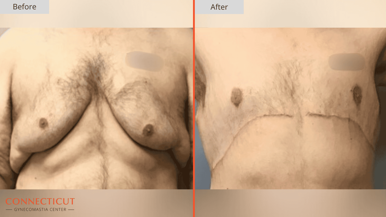 Connecticut Gynecomastia Center Before After 17D