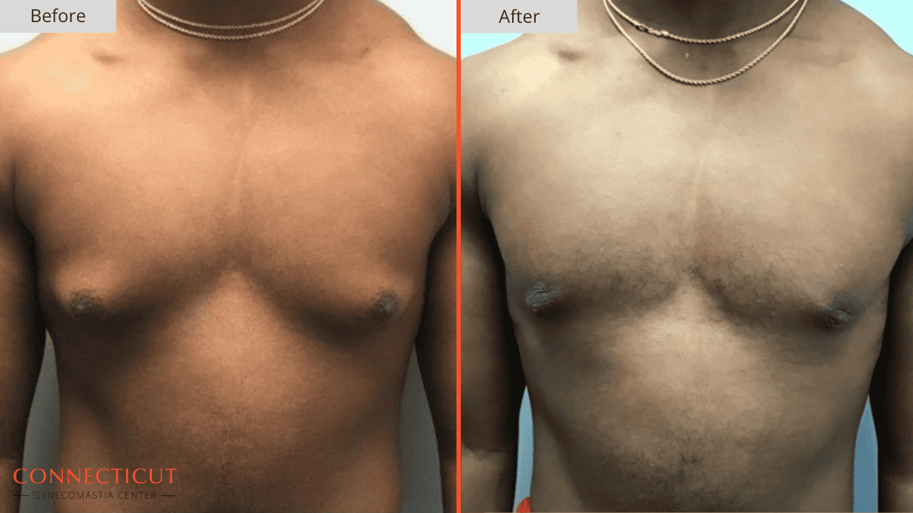 Connecticut Gynecomastia Center Before After 18D