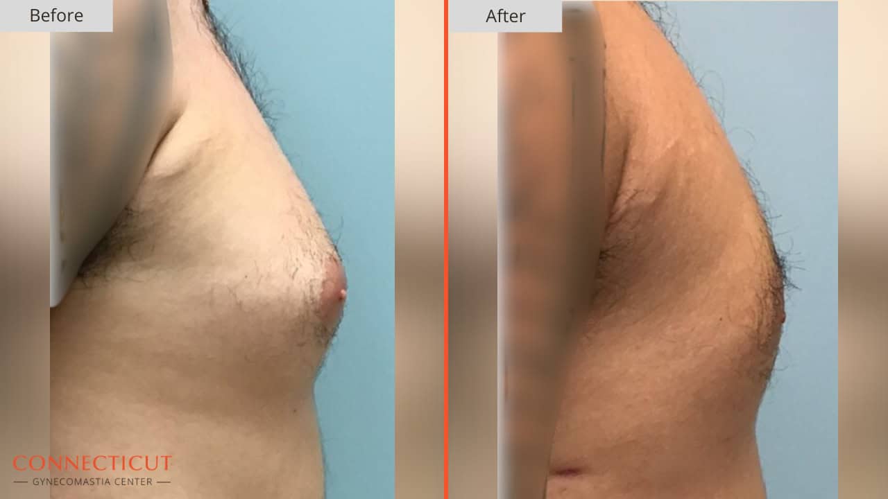 Connecticut Gynecomastia Center Before After 19B