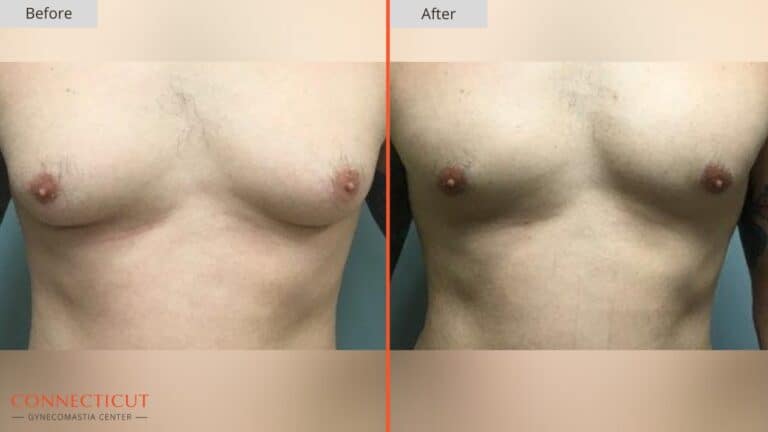 Connecticut Gynecomastia Center Before After 1A