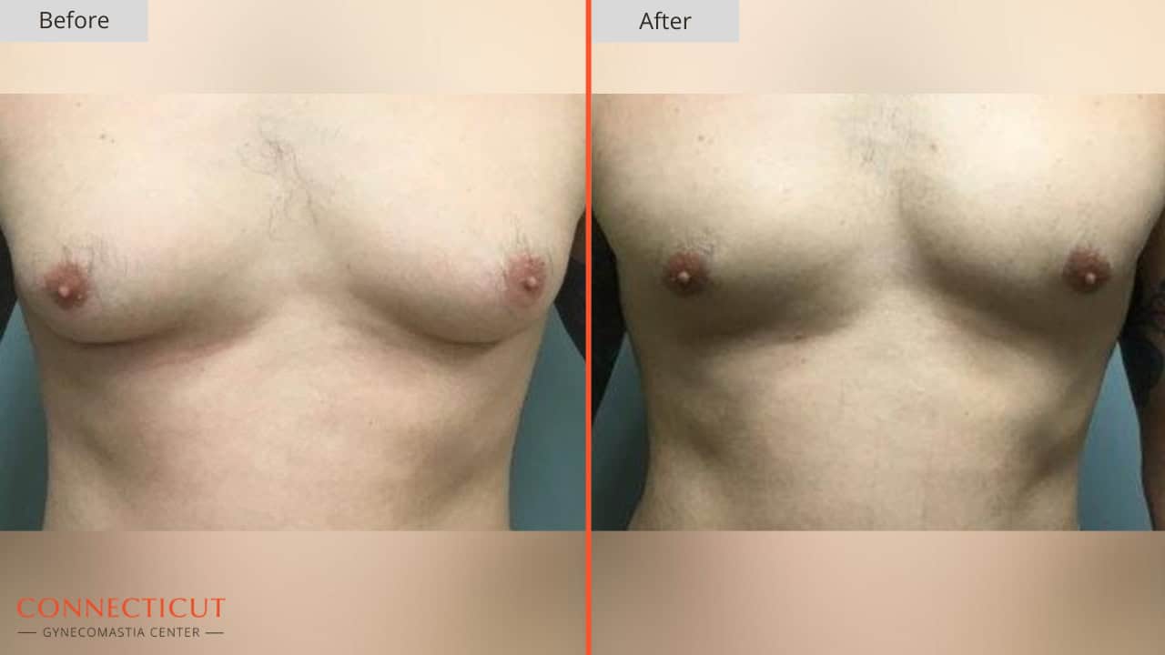Connecticut Gynecomastia Center Before After 1A