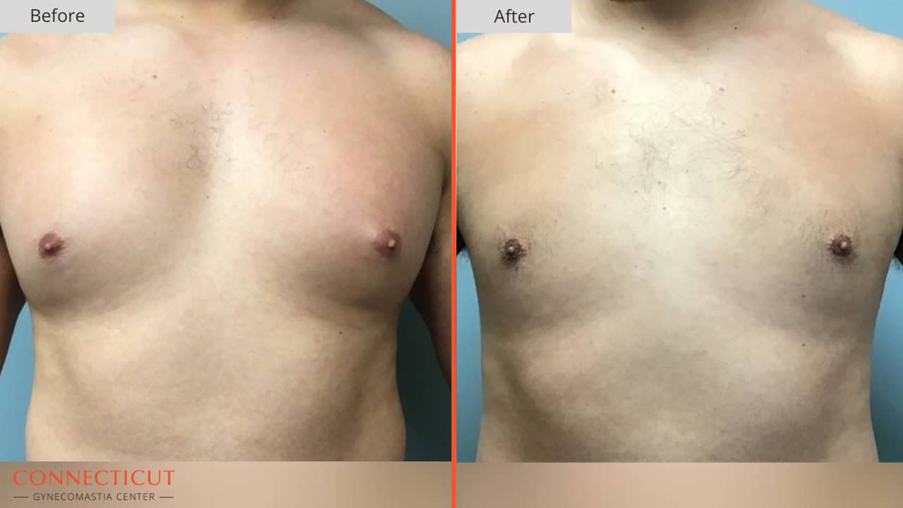 Connecticut Gynecomastia Center Before After 20B