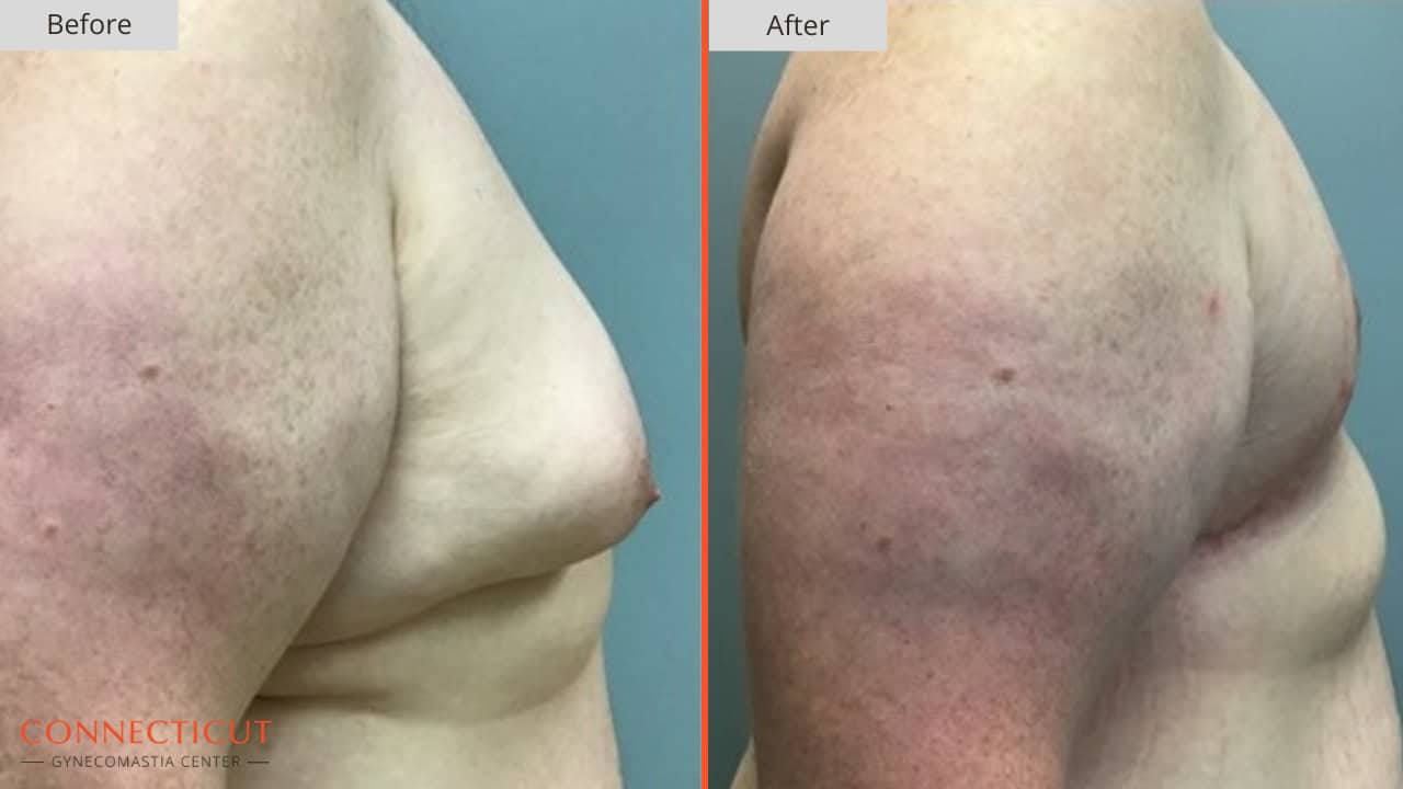 Connecticut Gynecomastia Center Before After 21B