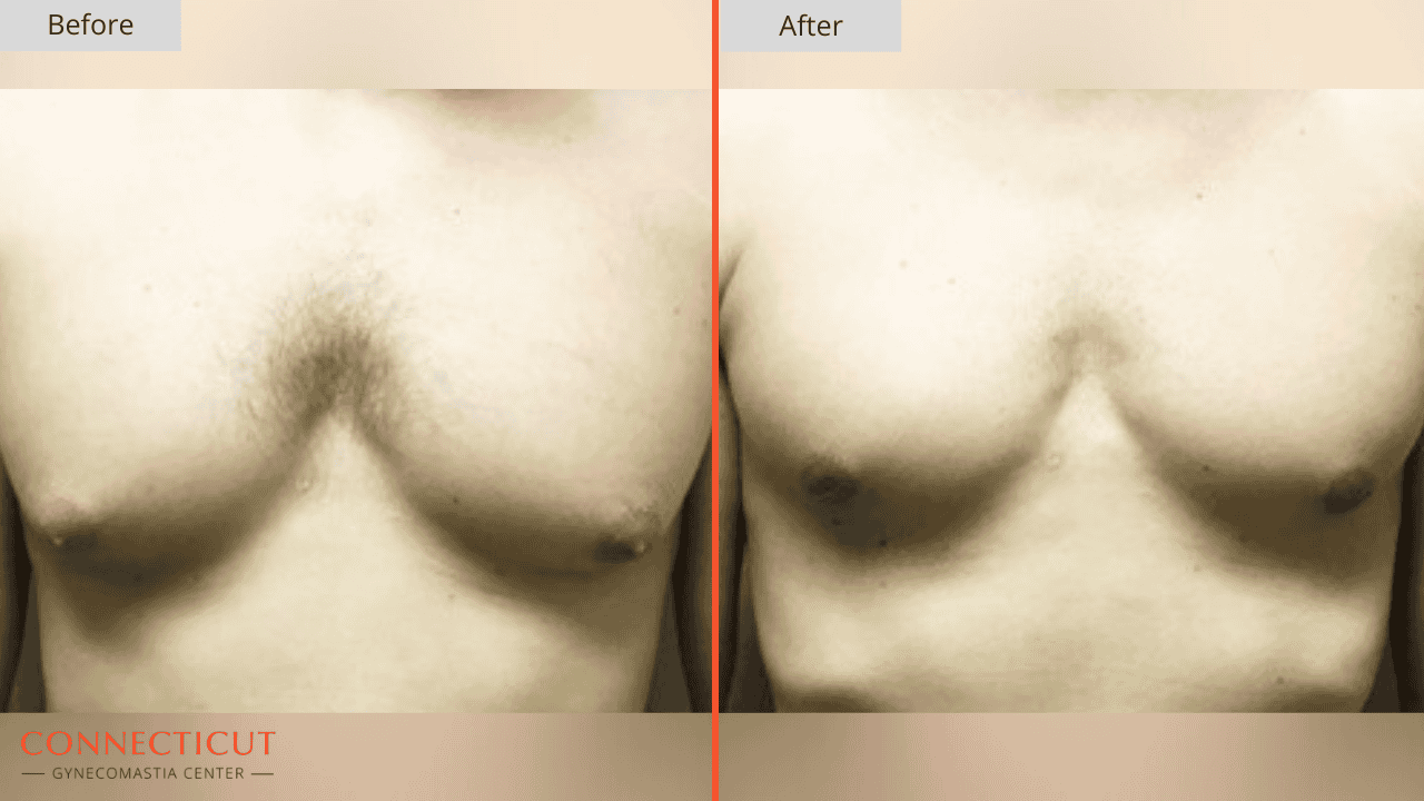 Connecticut Gynecomastia Center Before After 22D