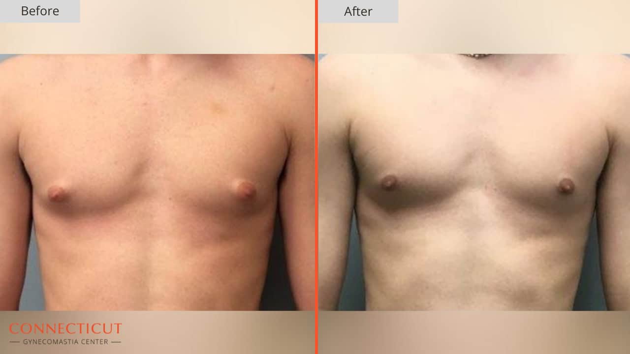 Connecticut Gynecomastia Center Before After 23B