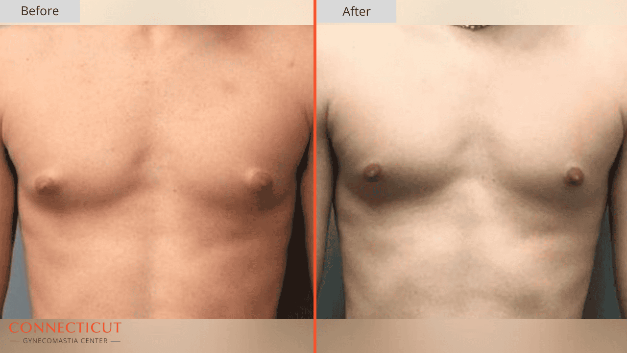 Connecticut Gynecomastia Center Before After 23D
