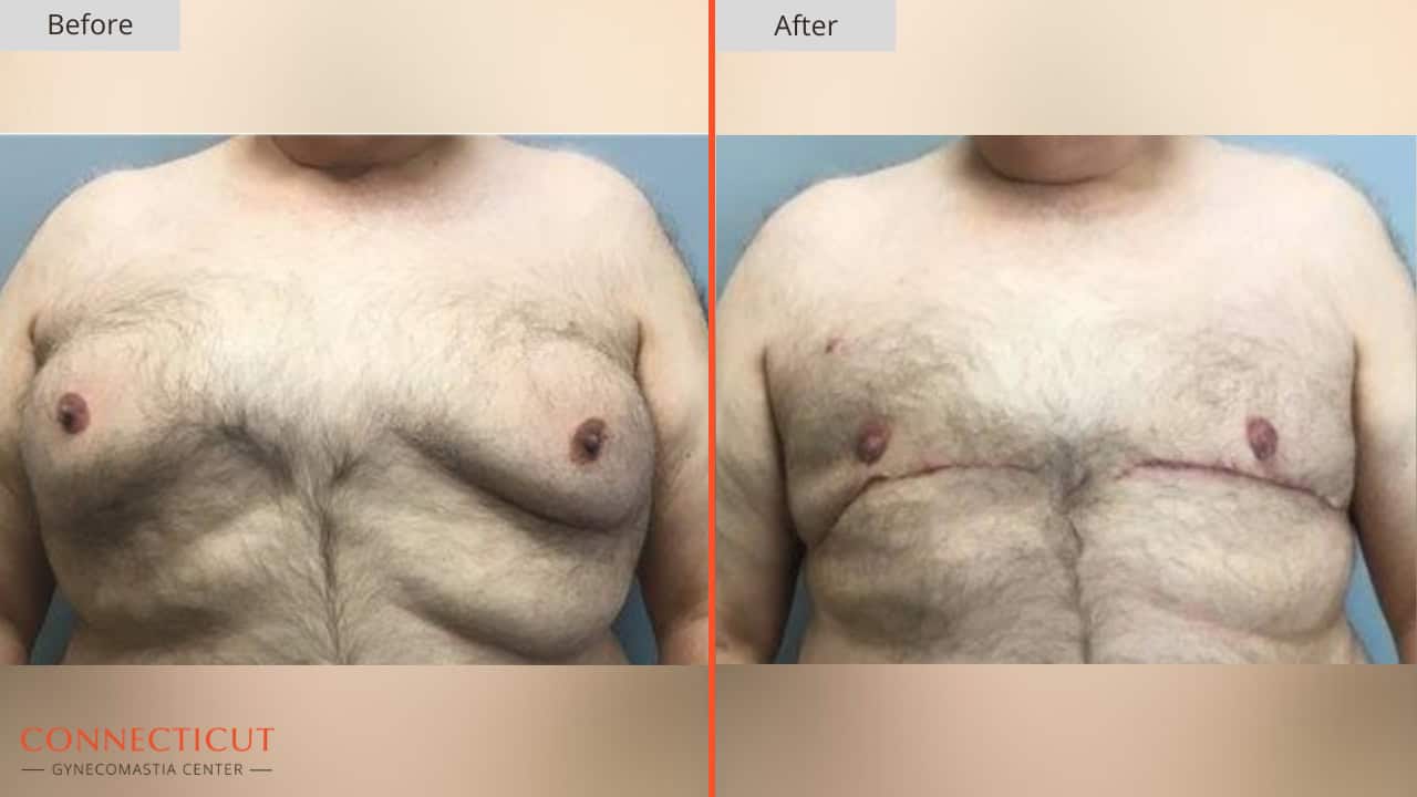 Connecticut Gynecomastia Center Before After 24A