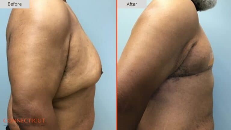 Connecticut Gynecomastia Center Before After 2A