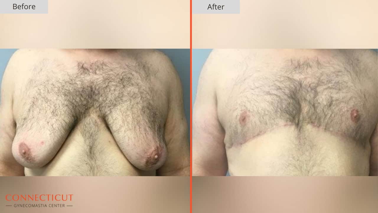 Connecticut Gynecomastia Center Before After 3A