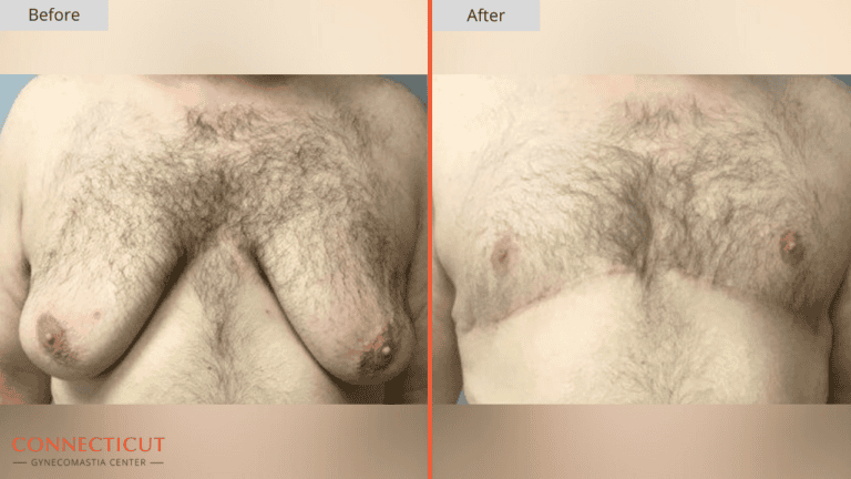 Connecticut Gynecomastia Center Before After 3D