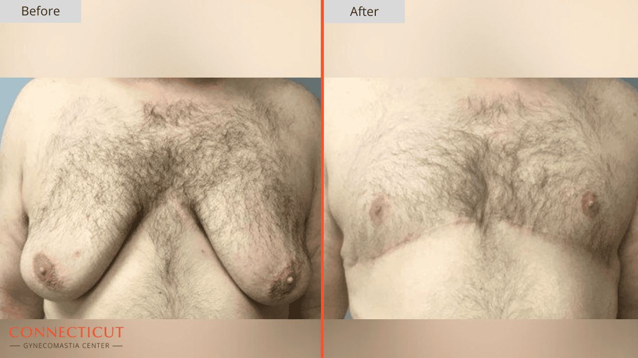 Connecticut Gynecomastia Center Before After 3D