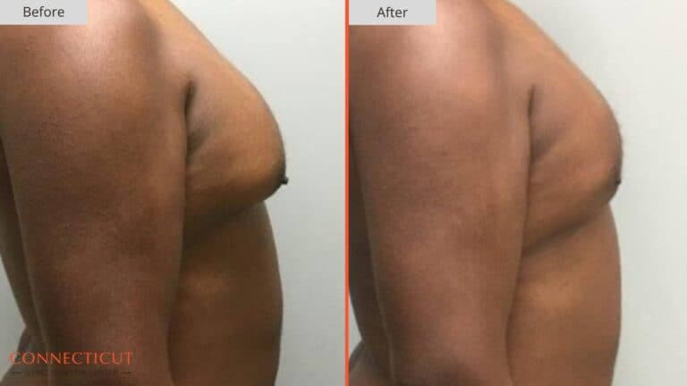 Connecticut Gynecomastia Center Before After 4A