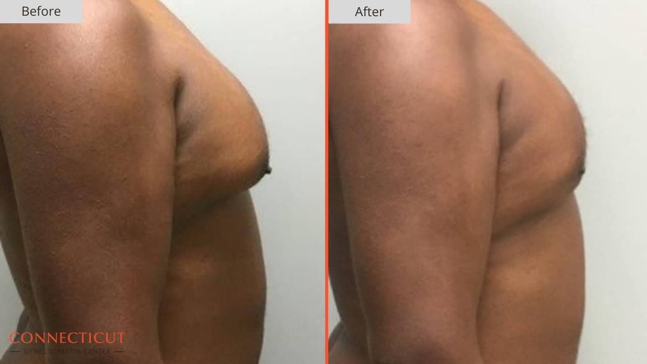 Connecticut Gynecomastia Center Before After 4A