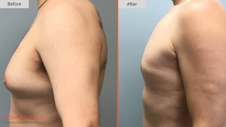 Connecticut Gynecomastia Center Before After 5A