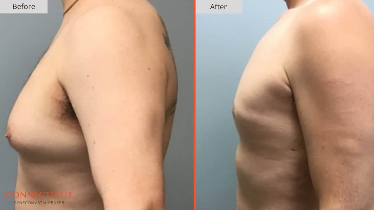 Connecticut Gynecomastia Center Before After 5A