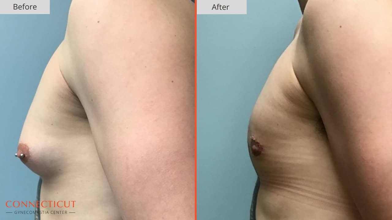 Connecticut Gynecomastia Center Before After 6A