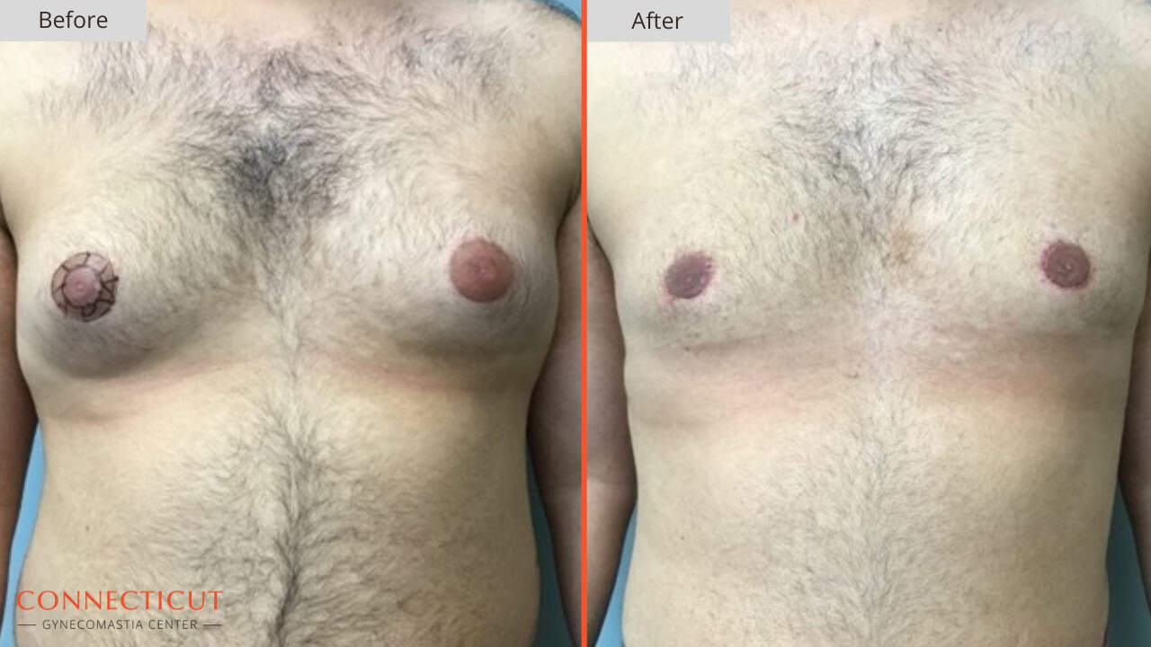 Connecticut Gynecomastia Center Before After 7C