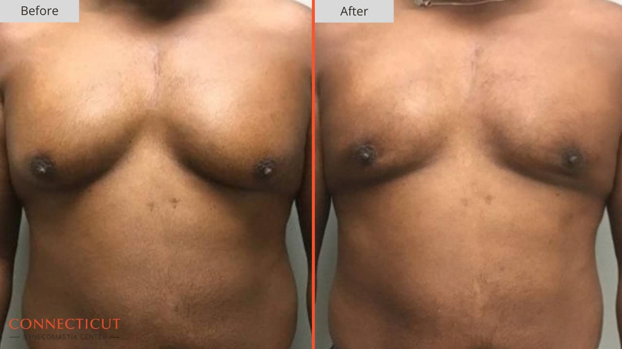 Connecticut Gynecomastia Center Before After 8A