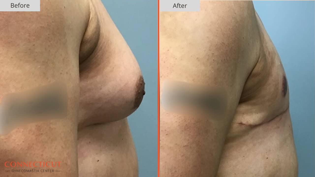 Connecticut Gynecomastia Center Before After 9A