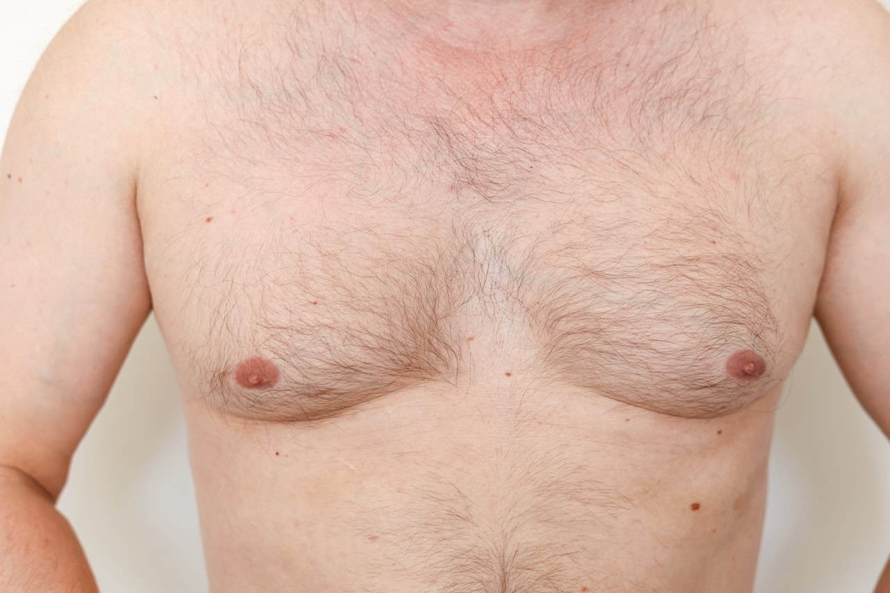 Gynecomastia Pre Surgery