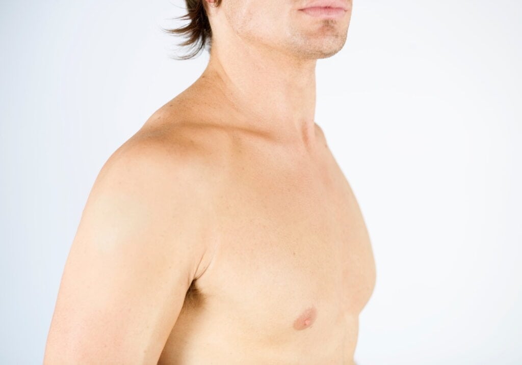 Gynecomastia Revision