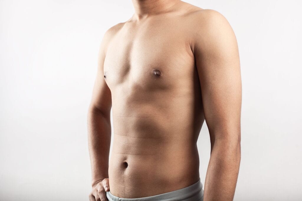 Male teenager with gynecomastia showing enlarged breast tissue.