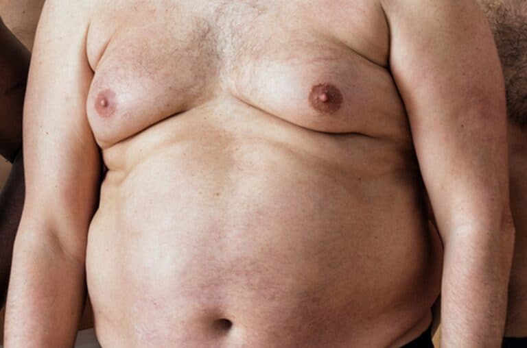overweight male with severe chest growth